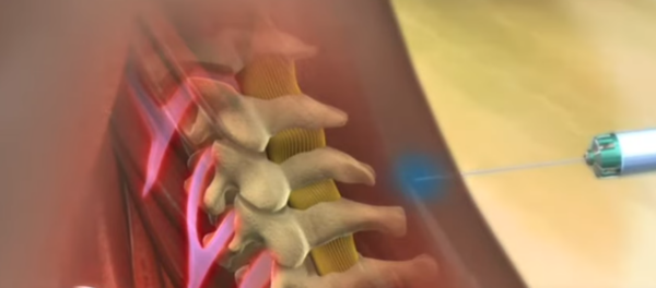 Cervical Epidural Steroid Injections - Corpus Christi Pain Medicine